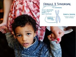Fragile X Syndrome (FXS)_ What It Is, Symptoms & Treatment