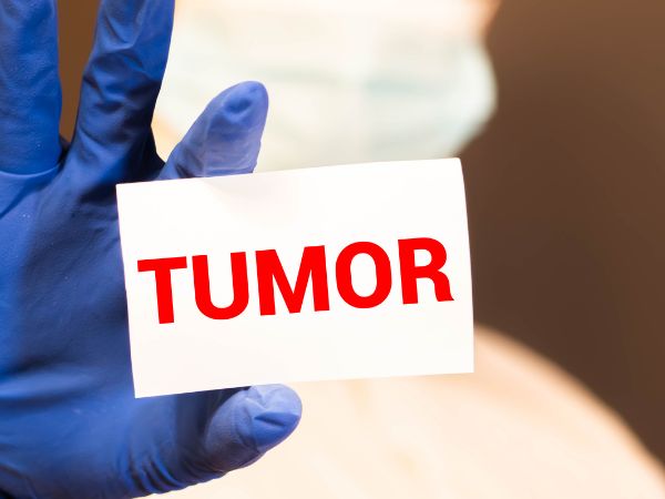 Overview of Tumor Detection and Prevention