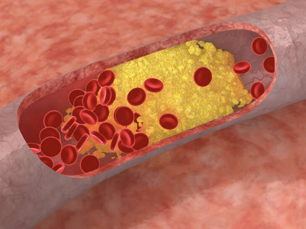 Causes and Risk Factors of Aortic Aneurysms