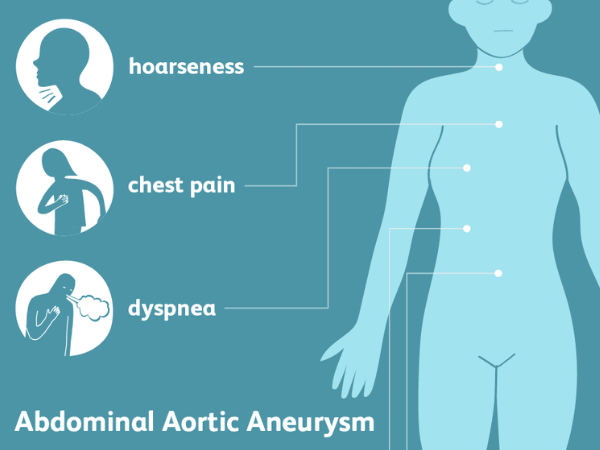 Symptoms of Aortic Aneurysms