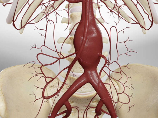 What is an Aortic Aneurysm