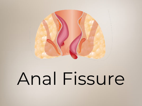 What is an anal fissure