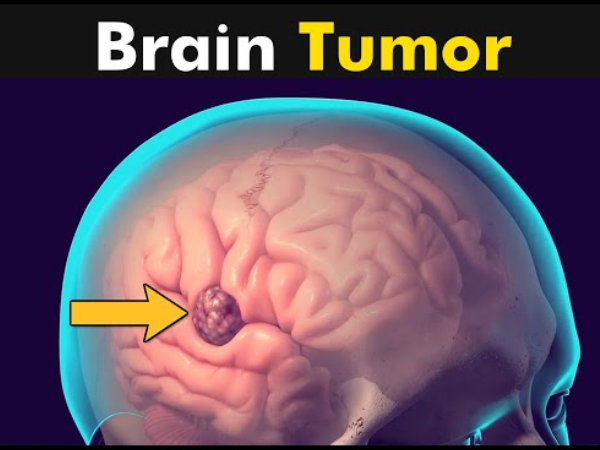 Treatment of Brain Tumors