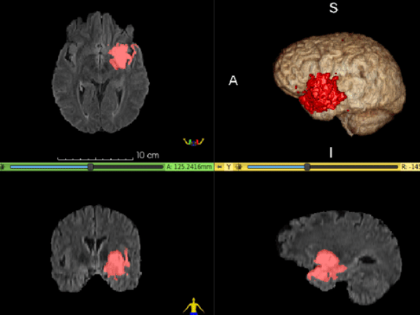 Types of Brain Tumors