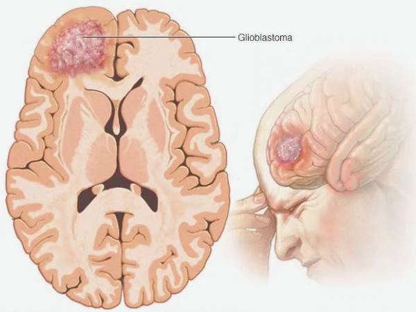 What are the Types of Brain Cancer