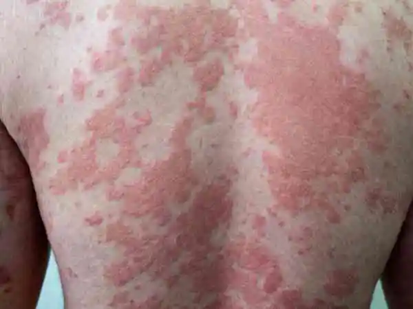 Psoriasis