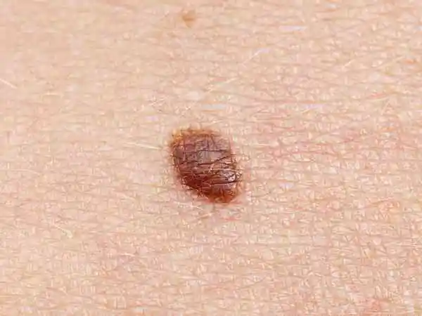 Basal Cell Carcinoma