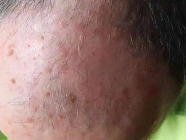 Actinic Keratosis