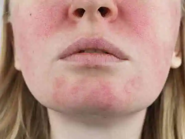 Rosacea