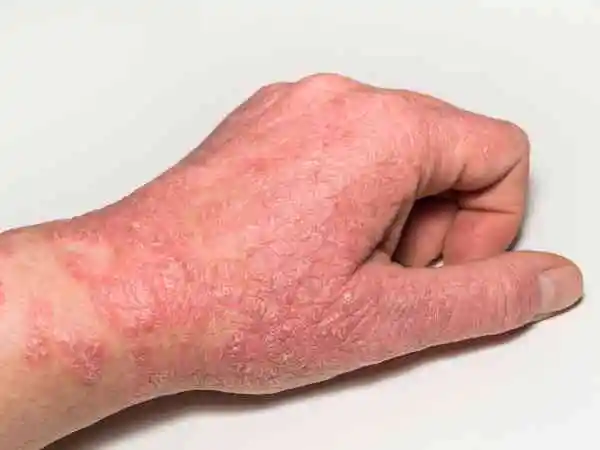 Eczema