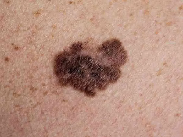 Melanoma