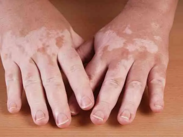 Vitiligo